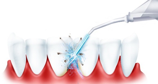  Водна струя в иригатора