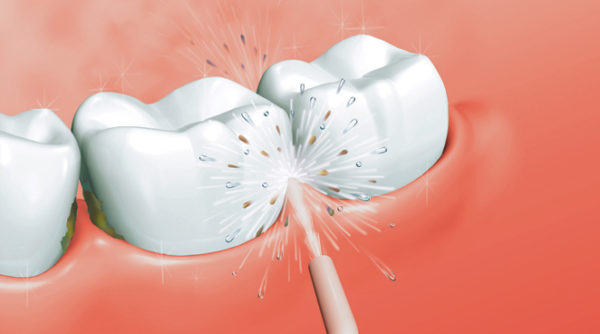  Почистване на зъбите с напоител