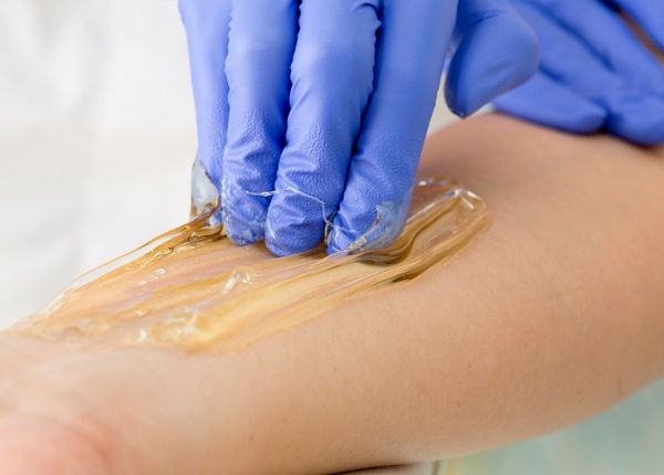  Епилация на захарта