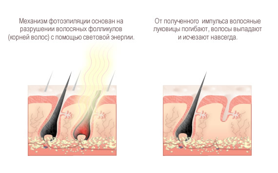  Принципът на фотоепилация