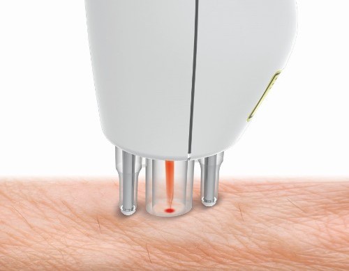  Работата на лазерния епилатор