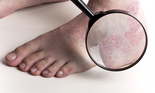  Екзема на краката