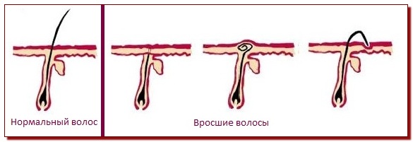  Врастна коса